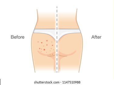 Buttocks with many pimples and after skin treatment. Illustration about health care.