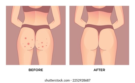 Buttocks with red pimples, Before and after skin treatment.