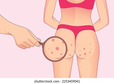 Buttocks with red pimples. skin bubble rash