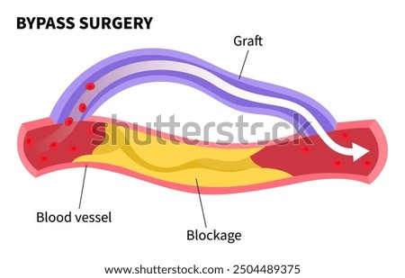 Bypass surgery for Peripheral artery disease with foot ulcer of clot leg veins by fatty or injury that cause pain and High blood pressure