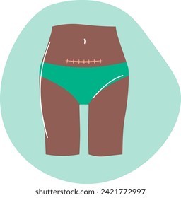Caesarean section (C-section) is a surgical procedure for delivering a baby through an incision in the mother's abdomen and uterus, often performed when a natural birth is not advisable