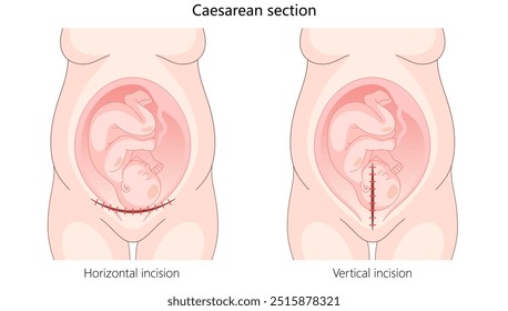 caesarean section with horizontal and vertical incisions for delivering a baby through surgical methods hand drawn schematic vector illustration. Medical science educational illustration