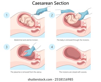 procedimento de cesariana mostrando etapas. incisão, remoção do bebê, remoção da placenta, sutura de incisões diagrama desenhado à mão ilustração vetorial esquemático. Ilustração educacional de ciências médicas