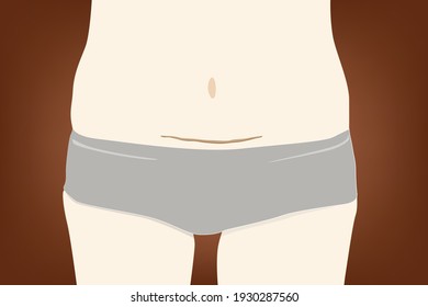 Caesarean section  is the surgical procedure by which a baby is delivered through an incision in the mother's abdomen