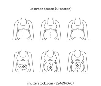 Caesarean section views icon line in vector, illustration of a pregnant woman.
