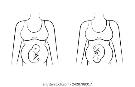 Caesarean section views icon line in vector, illustration of a pregnant woman 4 4 5