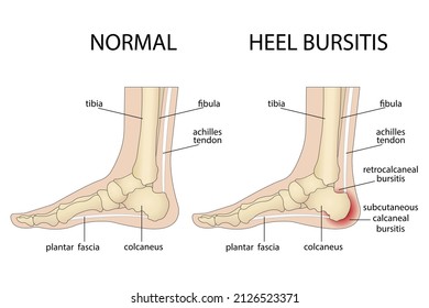 Calcaneal bursitis. Foot with normal heel and foot with Haglund's deformity and bursitis