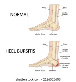 Calcaneal bursitis. Foot with normal heel and foot with Haglund's deformity and bursitis