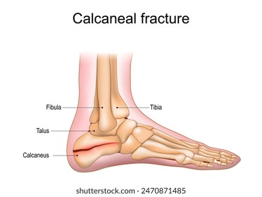 Calcaneal fracture. Trauma of Heel bone. Foot injury. Anatomy of foot joints. Vector illustration