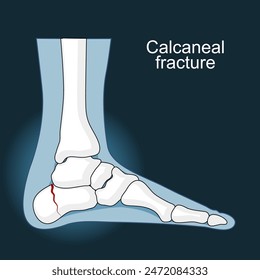 Calcaneal fracture. Trauma of Heel bone. Foot injury. Anatomy of foot joints. icons like x-ray image. Disease and disorder in a heel. Flat vector illustration.