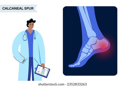 Calcaneal spur Anatomie. Fußproblem, Diagnose und Behandlung in der Podiatrie Klinik. Schäle Knochenwachstum durch Kalkaninentuberfett. Knöchelschmerzen und Schwellungen. Röntgenuntersuchung der Füße, Vektorgrafik