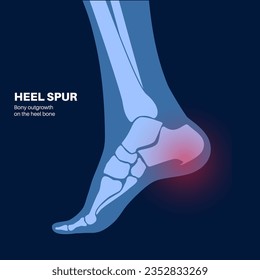 Calcaneal spur Anatomie. Fußproblem, Diagnose und Behandlung in der Podiatrie Klinik. Schäle Knochenwachstum durch Kalkaninentuberfett. Knöchelschmerzen und Schwellungen. Röntgenuntersuchung der Füße, Vektorgrafik