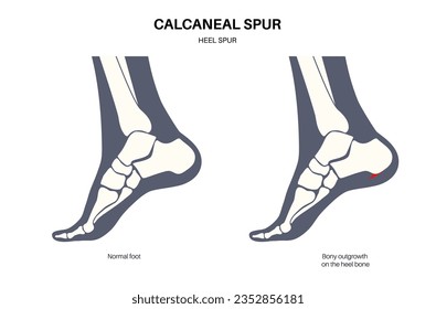 Calcaneal spur Anatomie. Fußproblem, Diagnose und Behandlung in der Podiatrie Klinik. Schäle Knochenwachstum durch Kalkaninentuberfett. Knöchelschmerzen und Schwellungen. Röntgenuntersuchung der Füße, Vektorgrafik