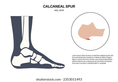 Calcaneal spur anatomy. Foot problem, diagnostic and treatment in podiatry clinic. Heel bone outgrowth from calcaneal tuberosity. Ankle pain and swelling. X ray examination of feet vector illustration