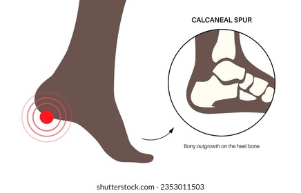Calcaneal spur anatomy. Foot problem, diagnostic and treatment in podiatry clinic. Heel bone outgrowth from calcaneal tuberosity. Ankle pain and swelling. X ray examination of feet vector illustration