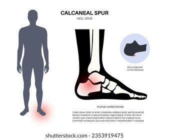Calcaneal spur anatomy. Foot problem, diagnostic and treatment in podiatry clinic. Heel bone outgrowth from calcaneal tuberosity. Ankle pain and swelling. X ray examination of feet vector illustration