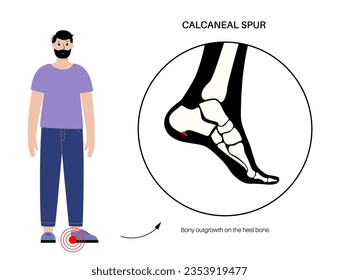 Calcaneal spur anatomy. Foot problem, diagnostic and treatment in podiatry clinic. Heel bone outgrowth from calcaneal tuberosity. Ankle pain and swelling. X ray examination of feet vector illustration