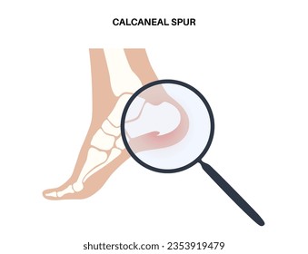 Calcaneal spur anatomy. Foot problem, diagnostic and treatment in podiatry clinic. Heel bone outgrowth from calcaneal tuberosity. Ankle pain and swelling. X ray examination of feet vector illustration