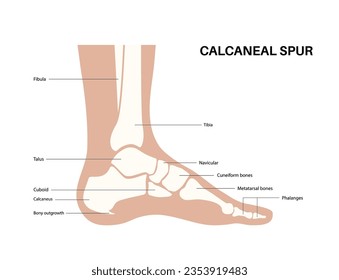 Calcaneal spur anatomy. Foot problem, diagnostic and treatment in podiatry clinic. Heel bone outgrowth from calcaneal tuberosity. Ankle pain and swelling. X ray examination of feet vector illustration