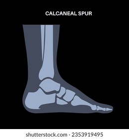 Calcaneal spur anatomy. Foot problem, diagnostic and treatment in podiatry clinic. Heel bone outgrowth from calcaneal tuberosity. Ankle pain and swelling. X ray examination of feet vector illustration