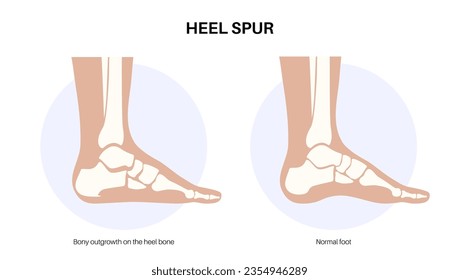 Calcaneal spur Anatomie. Fußproblem, Diagnose und Behandlung in der Podiatrie Klinik. Schäle Knochenwachstum durch Kalkaninentuberfett. Knöchelschmerzen und Schwellungen. Röntgenuntersuchung der Füße, Vektorgrafik