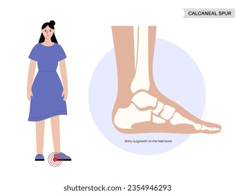 Calcaneal spur anatomy. Foot problem, diagnostic and treatment in podiatry clinic. Heel bone outgrowth from calcaneal tuberosity. Ankle pain and swelling. X ray examination of feet vector illustration