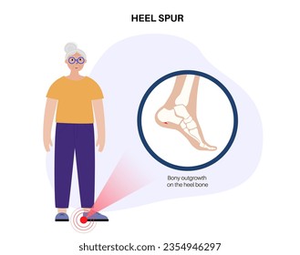 Calcaneal spur anatomy. Foot problem, diagnostic and treatment in podiatry clinic. Heel bone outgrowth from calcaneal tuberosity. Ankle pain and swelling. X ray examination of feet vector illustration