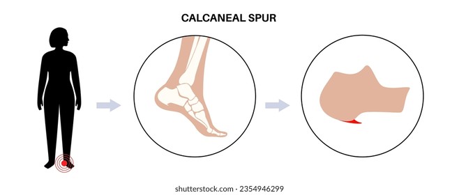 Calcaneal spur anatomy. Foot problem, diagnostic and treatment in podiatry clinic. Heel bone outgrowth from calcaneal tuberosity. Ankle pain and swelling. X ray examination of feet vector illustration