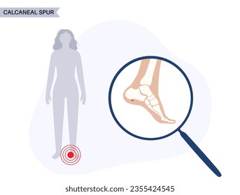 Calcaneal spur anatomy. Foot problem, diagnostic and treatment in podiatry clinic. Heel bone outgrowth from calcaneal tuberosity. Ankle pain and swelling. X ray examination of feet vector illustration
