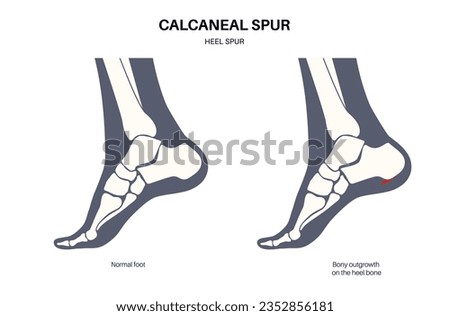 Calcaneal spur anatomy. Foot problem, diagnostic and treatment in podiatry clinic. Heel bone outgrowth from calcaneal tuberosity. Ankle pain and swelling. X ray examination of feet vector illustration