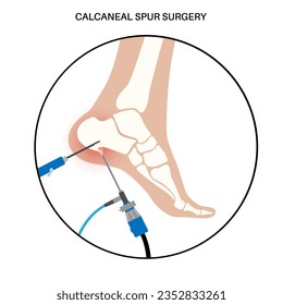 Calcaneal spur arthroscopic surgery. Foot problem, diagnostic and treatment. Heel bone outgrowth from calcaneal tuberosity. Ankle pain and swelling. X ray examination of feet flat vector illustration