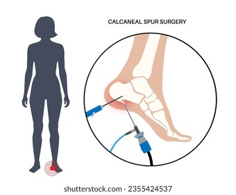 Calcaneal spur arthroscopic surgery. Foot problem, diagnostic and treatment. Heel bone outgrowth from calcaneal tuberosity. Ankle pain and swelling. X ray examination of feet flat vector illustration