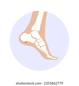 Calcaneal spur icon. Foot problem, diagnostic and treatment in a podiatry clinic. Heel bone outgrowth from calcaneal tuberosity. Ankle pain and swelling. X ray examination of feet vector illustration