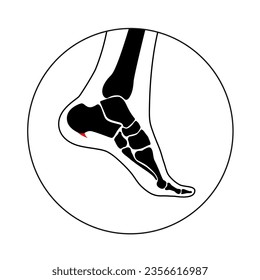 Calcaneal spur icon. Foot problem, diagnostic and treatment in a podiatry clinic. Heel bone outgrowth from calcaneal tuberosity. Ankle pain and swelling. X ray examination of feet vector illustration