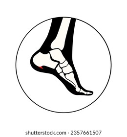 Calcaneal spur icon. Foot problem, diagnostic and treatment in a podiatry clinic. Heel bone outgrowth from calcaneal tuberosity. Ankle pain and swelling. X ray examination of feet vector illustration