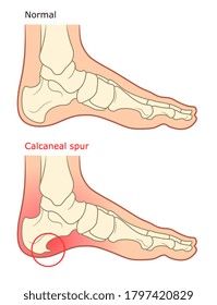 Calcaneal spur illustration. Healthy foot and diseased foot with spur. 