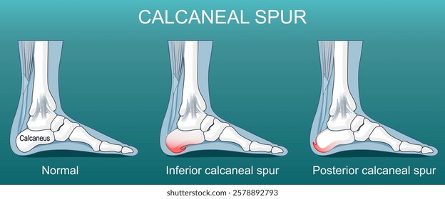 Calcaneal spur. Osteophytes on the posterior and inferior aspects of the calcaneus. Heel spur. Plantar fasciitis. Achilles tendinopathy. Heel pain. Foot biomechanics. Plantar fascia