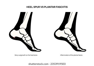 Calcaneal spur and plantar fasciitis comparison. Foot diseases treatment. Heel bone outgrowth or feet ligament inflammation. Ankle pain and swelling. X ray examination medical flat vector illustration