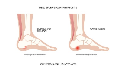 Calcaneal spur and plantar fasciitis comparison. Foot diseases treatment. Heel bone outgrowth or feet ligament inflammation. Ankle pain and swelling. X ray examination medical flat vector illustration