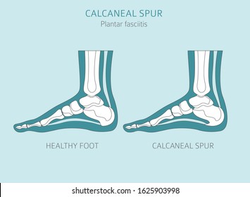 Calcaneal spur. Plantar fasciitis set. Medical desease infographics collection. Vector illustration