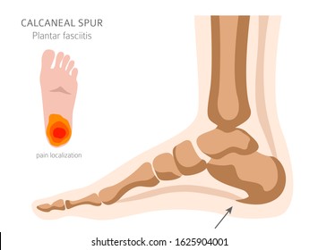 Calcaneal spur. Plantar fasciitis set. Medical desease infographics collection. Vector illustration