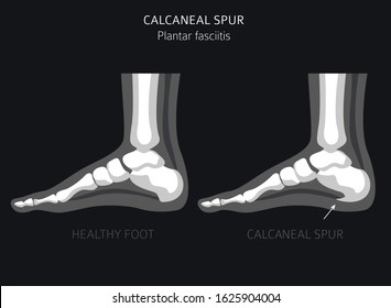 Calcaneal spur. Plantar fasciitis set. Medical desease infographics collection. Vector illustration