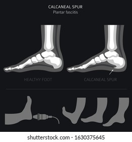 Calcaneal spur. Plantar fasciitis set. Medical desease infographics collection. Vector illustration