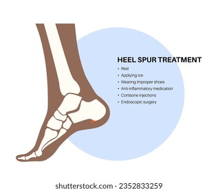 Calcaneal spur treatment. Foot problem, diagnostic and consult in podiatry clinic. Heel bone outgrowth from calcaneal tuberosity. Ankle pain and swelling. X ray examination of feet vector illustration