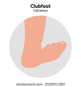 Calcaneus Clubfoot problema pé. Diagrama infográfico ortopédico