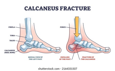 Calcaneus fracture anatomy with broken heel bone structure outline diagram. Labeled educational scheme with physical force direction to broke leg skeletal vector illustration. Medial view of left foot