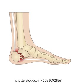 Calcaneus fracture. Foot injury Anatomy