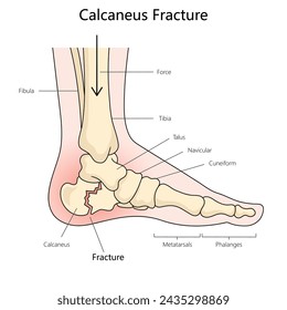 Calcaneus fracture structure diagram hand drawn schematic vector illustration. Medical science educational illustration