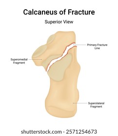 Calcaneus of Fracture Superior View