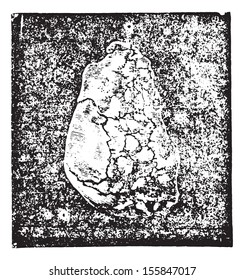 Cálculo de la enchatona de urato sódico en la mucosa de vejiga y extraída por tamaño prerectale (en perfil), ilustración vintage grabada. Diccionario de medicina habitual del Dr. Labarthe - 1885. 